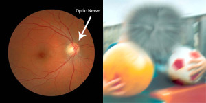 Optic Nerve | Visual Field Loss