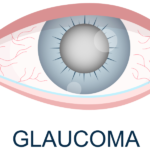 Glaucoma, Eyes