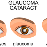 Glaucoma, Cataracts, Eyes