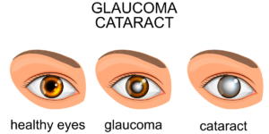 Glaucoma, Cataracts, Eyes